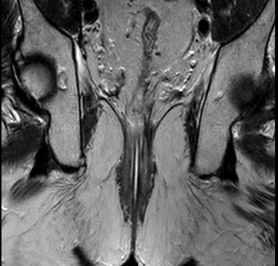 Irm Du Canal Anal D Finition D Roulement Prise De Rdv En Ligne
