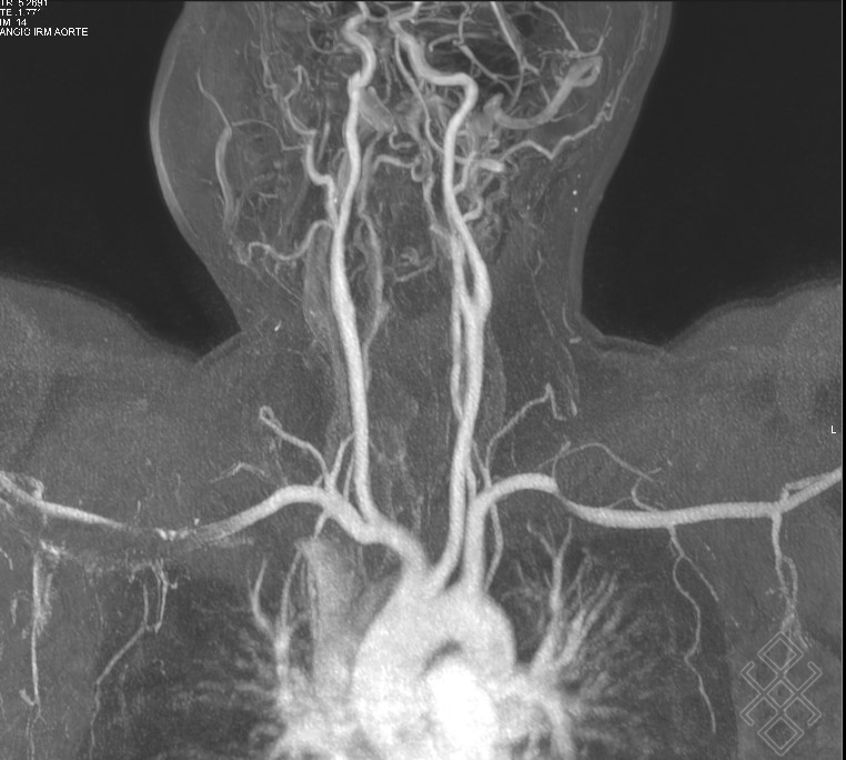 AngioIRM des Membres supérieurs Définition &