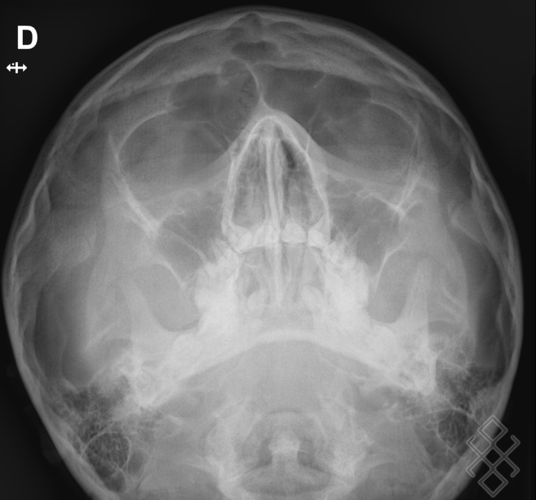 Radiographie des Os Propres du Nez (OPN) Définition & Déroulement