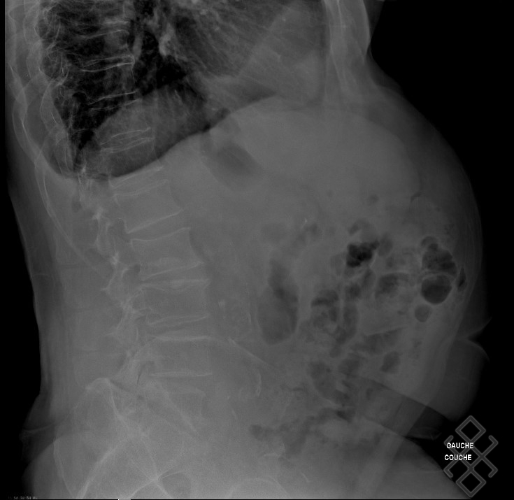 Radiographie ASP (Abdomen sans préparation) Définition & Déroulement