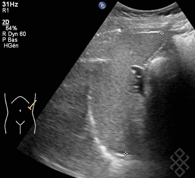Échographie Abdominopelvienne Définition & Déroulement Prise de rdv en ligne