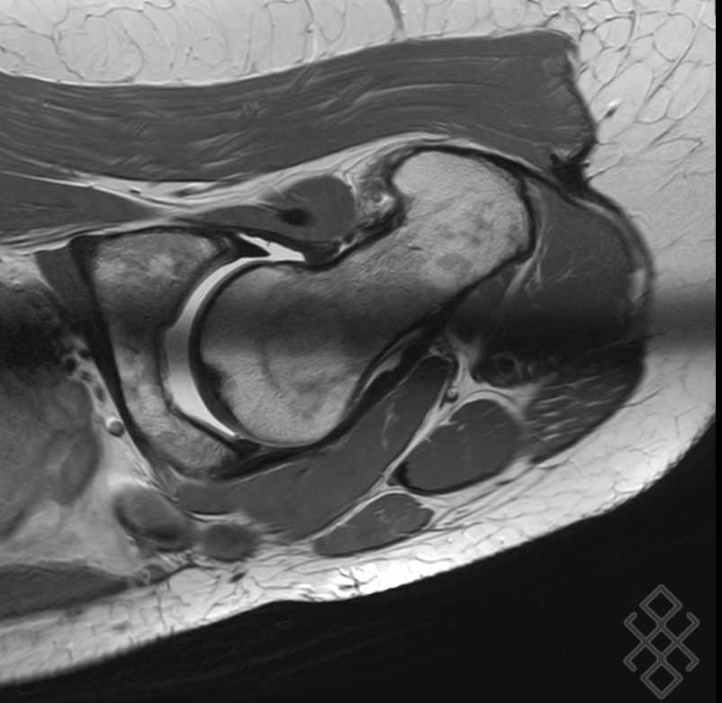ArthroIRM de la Hanche Définition & Déroulement Prise de rdv en ligne