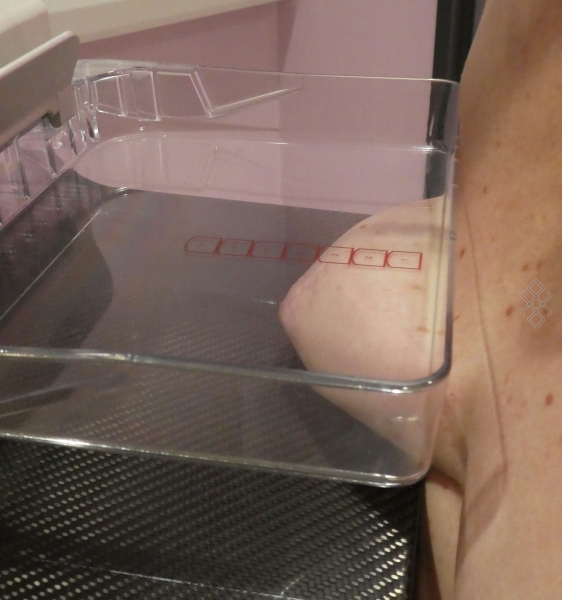 Déroulement Mammography