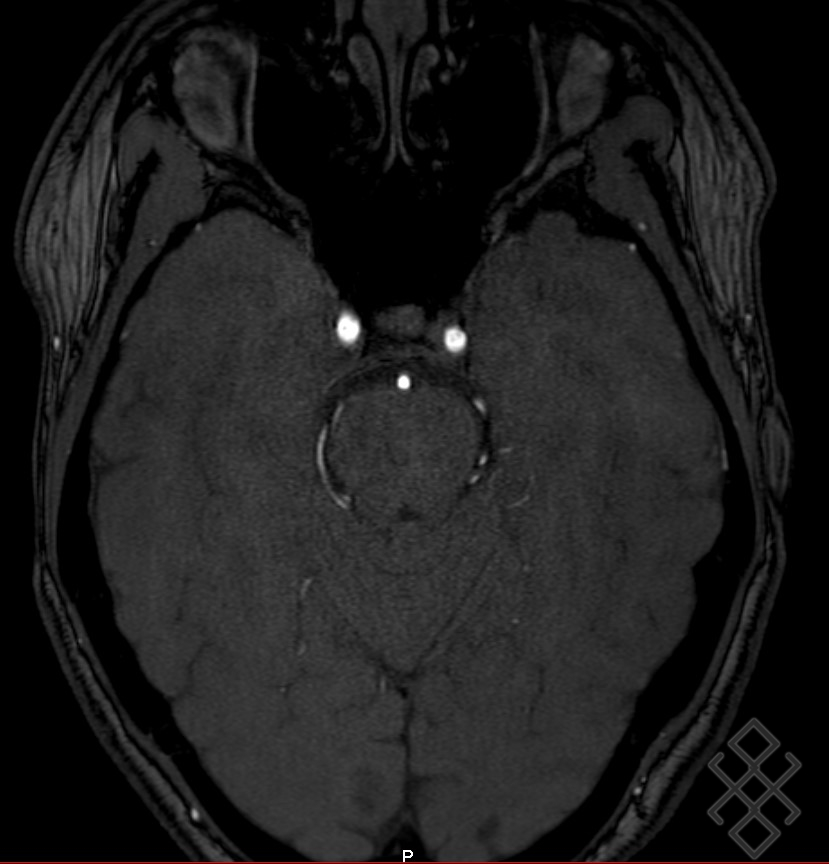 AngioIRM Cérébrale Définition & Déroulement Prise de rdv 100 en ligne
