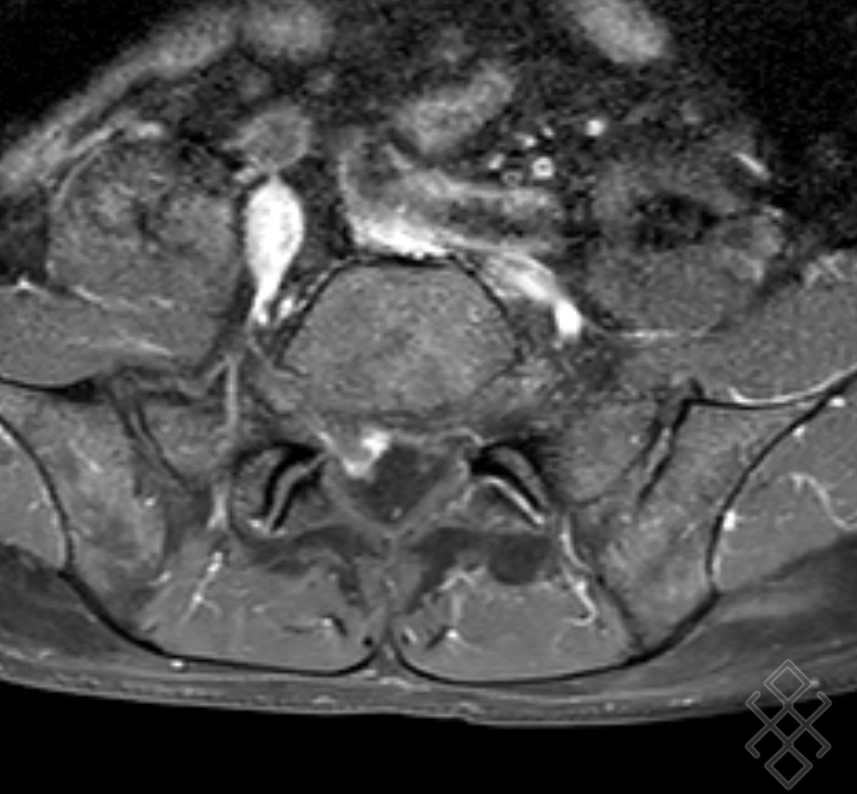 IRM Du Rachis Lombaire D finition D roulement Prise De Rdv En Ligne