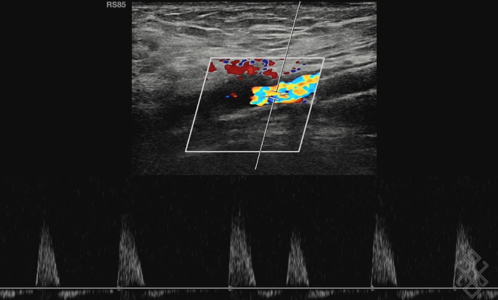 Rdv Echo Doppler Veineux Des Membres Inférieurs Doppler Veineux des Membres inférieurs - Définition & Déroulement