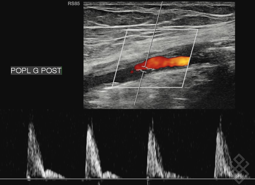 Rdv Echo Doppler Veineux Des Membres Inférieurs Doppler Veineux des Membres inférieurs - Définition & Déroulement