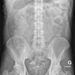 Radiographie ASP (Abdomen sans préparation) - Définition