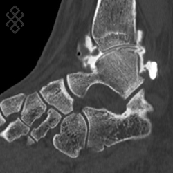 Arthroscanner de la Cheville - Définition & Déroulement - Prise de ...