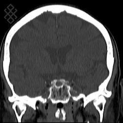 Scanner Cérébral - Définition & Déroulement - Prise de rdv en ligne