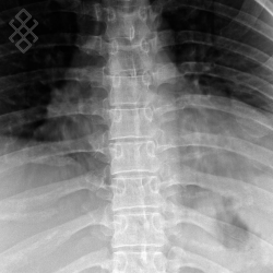 Radiographie du Rachis dorsal - Définition & Déroulement - Prise ...