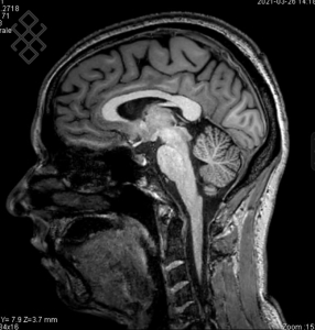 IRM Cérébrale