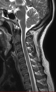 IRM du Rachis cervical