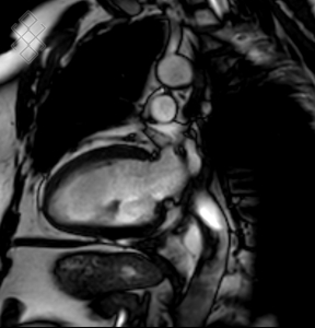 IRM Cardiaque morphologique