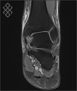 IRM de la Cheville