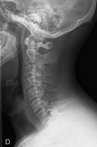 Radiographie du Rachis cervical