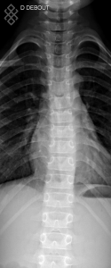 Radiographie du Rachis dorsal