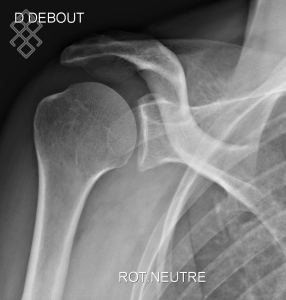 Radiographie de l’Épaule