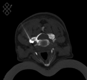 Infiltration Cervicale (sous Scanner)