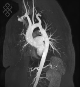 Angio-IRM Thoracique