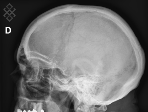 Radiographie du Crâne