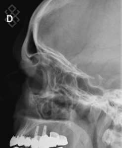 Radiographie des Sinus