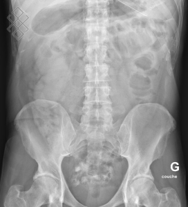 Radiographie ASP (Abdomen sans préparation)