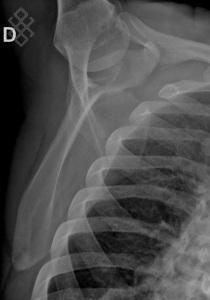 Radiographie de l’Omoplate