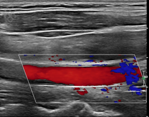 Doppler des Troncs Supra Aortiques (TSA)