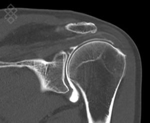 Protocol - Arthroscanner de l’Épaule