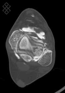 Protocol - Arthroscanner de la Cheville