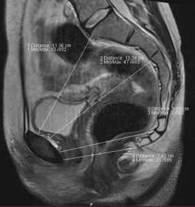 Radiographie Pelvimétrie