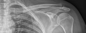 Radiographie de la Clavicule