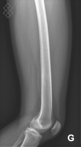 Radiographie de la Cuisse (fémur)