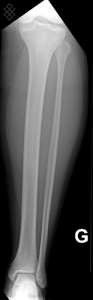 Radiographie de la Jambe (tibia, péroné)