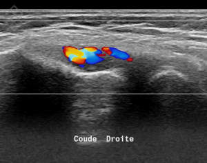 Échographie du Coude