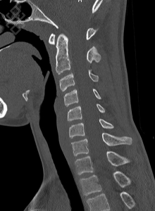 Scanner du Rachis cervical