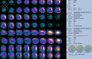 Scintigraphie Cardiaque