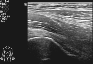 Échographie de la Hanche adulte