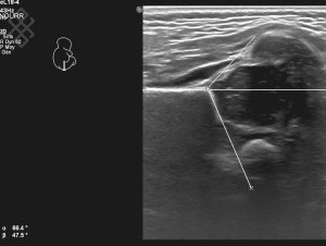 Échographie de la Hanche bébé