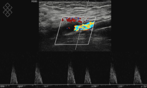 Doppler Veineux des Membres inférieurs